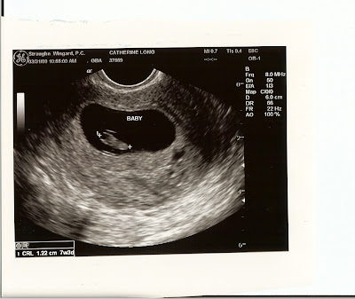 Healthy+heartbeat+at+7+weeks