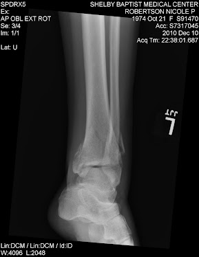 x ray #2 on the night of injury