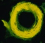 A ring of amyloid is visible in the wall of an arteriole in the brain of a patient who had Alzheimer's disease.