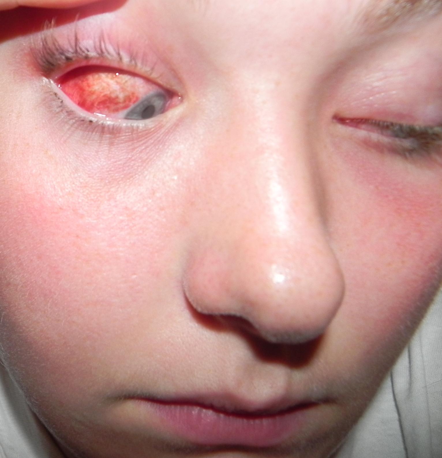 cambodian adventures: my pinkeye/blepharitis