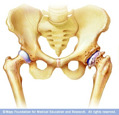 hip joint injury pill