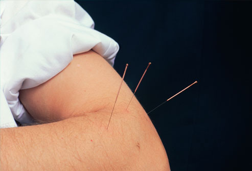 Acupuncture: Still The Sharp Choice Alternative Pain Relief Method