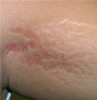 Estrias en las axilas_3