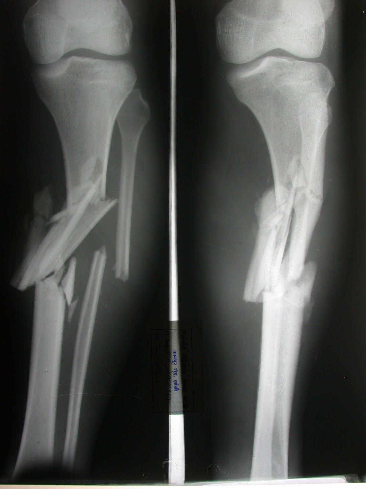 Science&Life: Bone Fractures