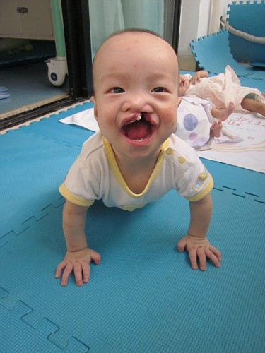 Kids With Cleft