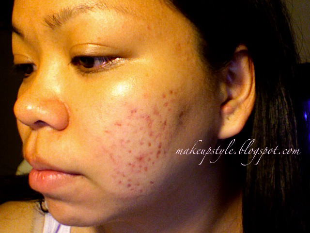white acne bumps