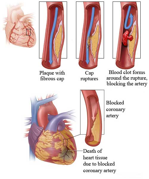 Symptoms of Heart Attack.
