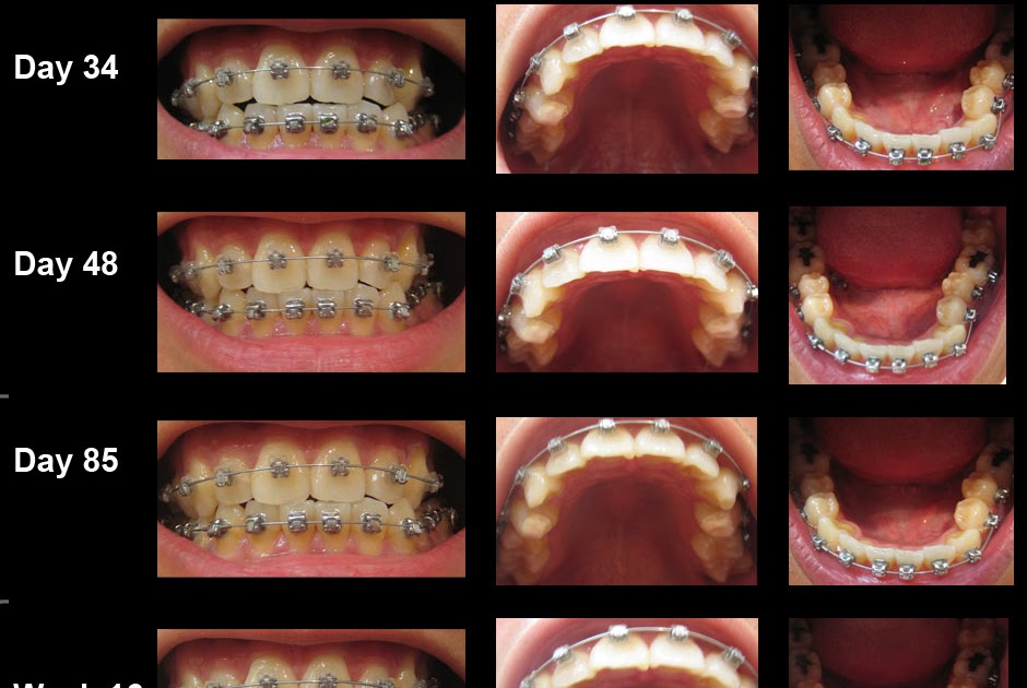My Journey with the Damon Braces Progress for the past 23 weeks in