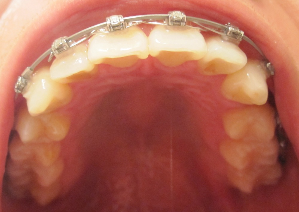 My Journey with the Damon Braces Week 41 Part 2 Ortho Appointment