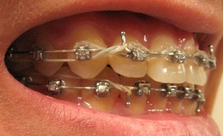braces damon bands rubber without journey