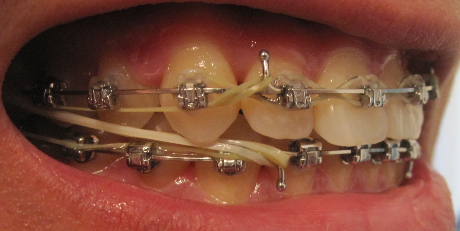 My Journey with the Damon Braces Week 73 with the Damon Braces