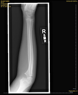 symptoms of adult buckle fracture wrist symptoms of adult buckle fracture wrist