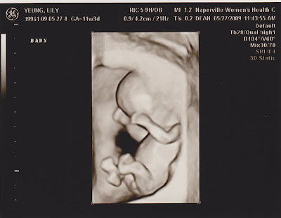 Baby Ultrasound at 11 weeks 3