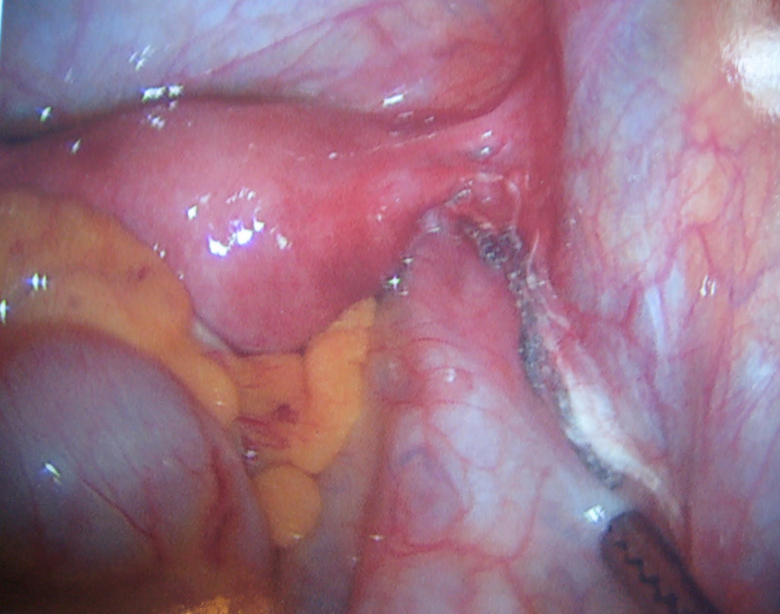Healthy Appendix Picture