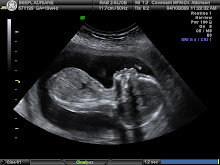 19 week Ultrasound
