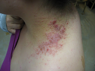 chemical burn rash