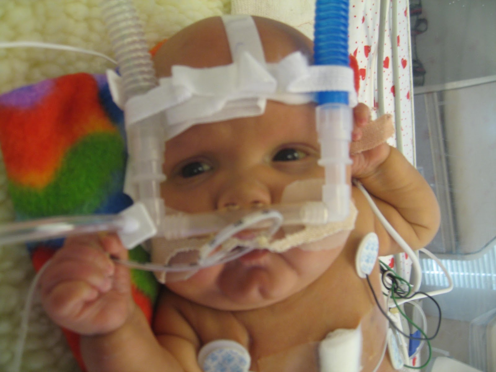 La Medicina a tu Alcance Ventilación con CPAP nasal.en neonatos.