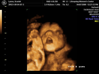 3d ultrasound pictures of twins. 3D Ultrasound at 23 Weeks