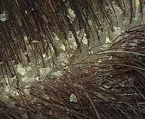 Herbs Blog Overcome Dandruff Naturally