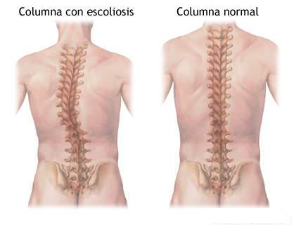 Que preparados de la escoliosis