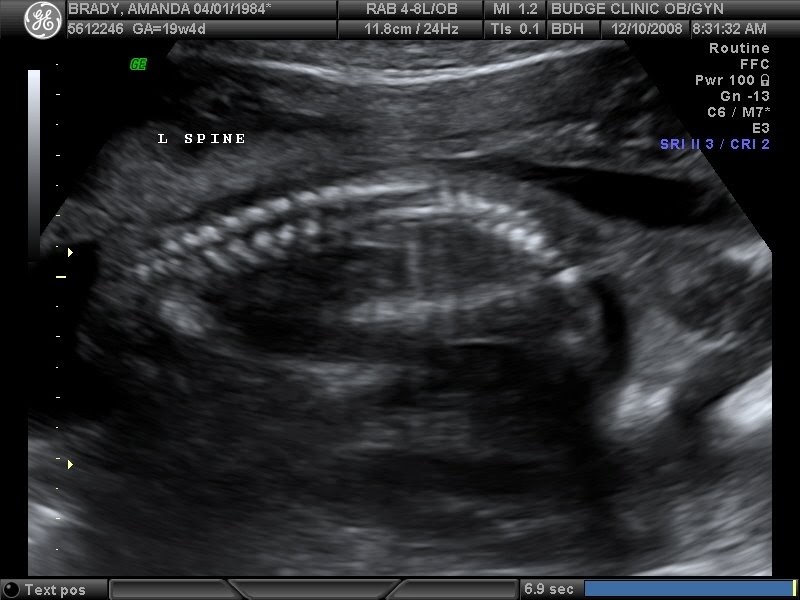 The Brady's Gastroschisis