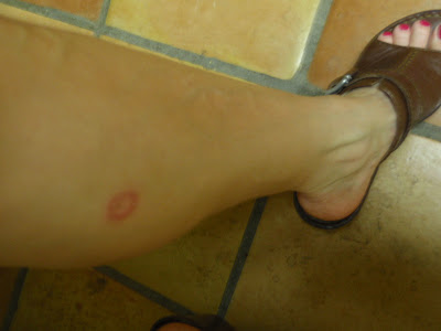 Arizona Spider Bites