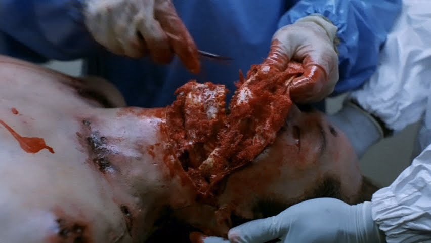 Ebola Syndrome