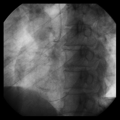 TRANSRADIAL PRIMARY PTCA TO