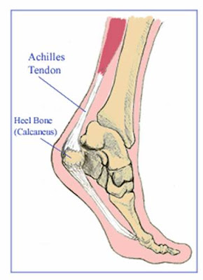 achilles tendonitis is