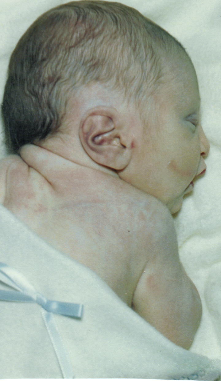 Potter's Syndrome What is Potters?