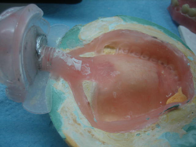 protesis flexible recien sacada de mufla