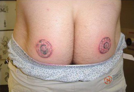 Breast Cancer Mastectomy Areola Nipple Tattoos