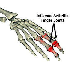 Arthritis Symptom