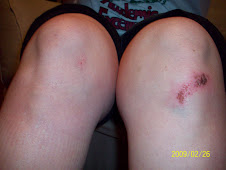 My poor knees after the fall