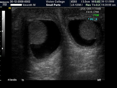scrotal ultrasound