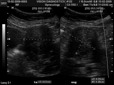  ... post menopausal bleed ultrasound showed a 4 6cm fibroid in her uterus