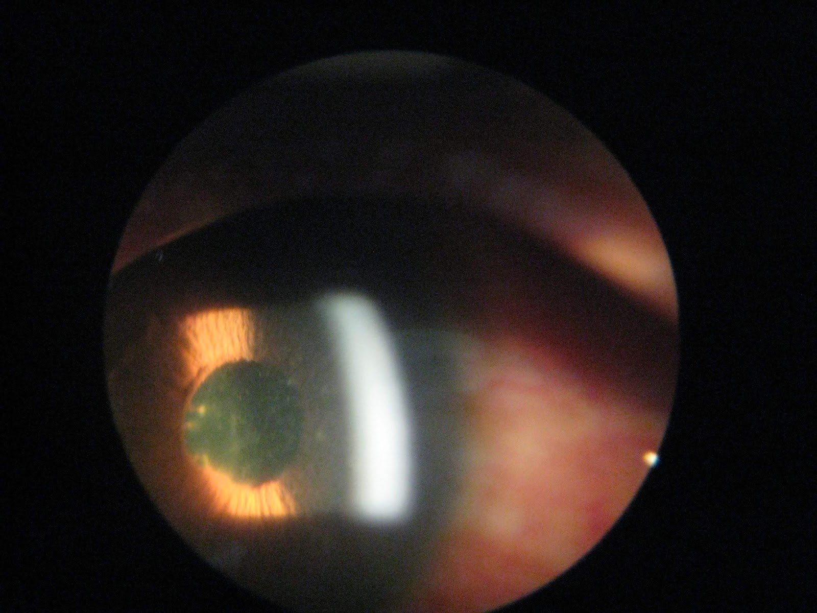 Eye Picturea case of Uveitis Take Care Of Your Eyes