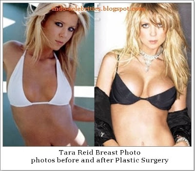 Tara Reid Plastic Surgery on Tara Reid Breast Plastic Surgery Pictures   Ready2beat