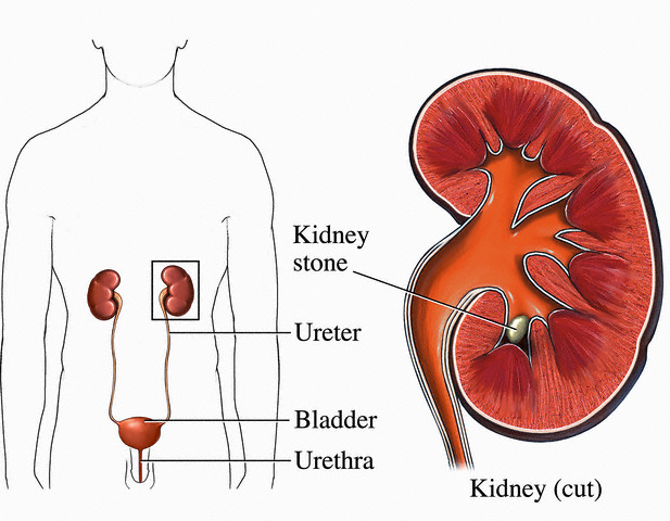 Kidney Sand Natural Remedies Kidney Sand Natural Remedies