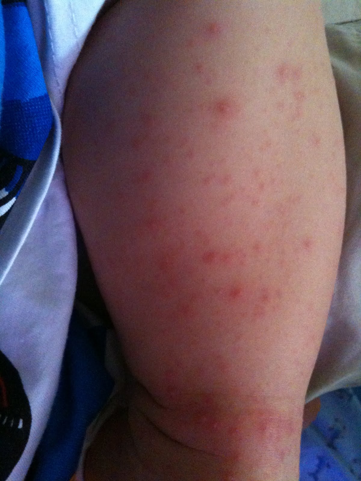 Hfmd Images