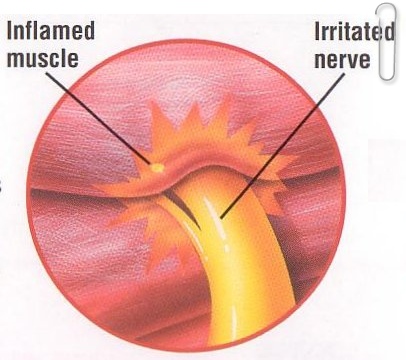 muscle+spasm.JPG