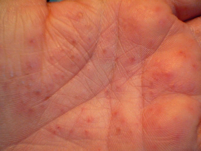 Como hacer la psoriasis no rojo
