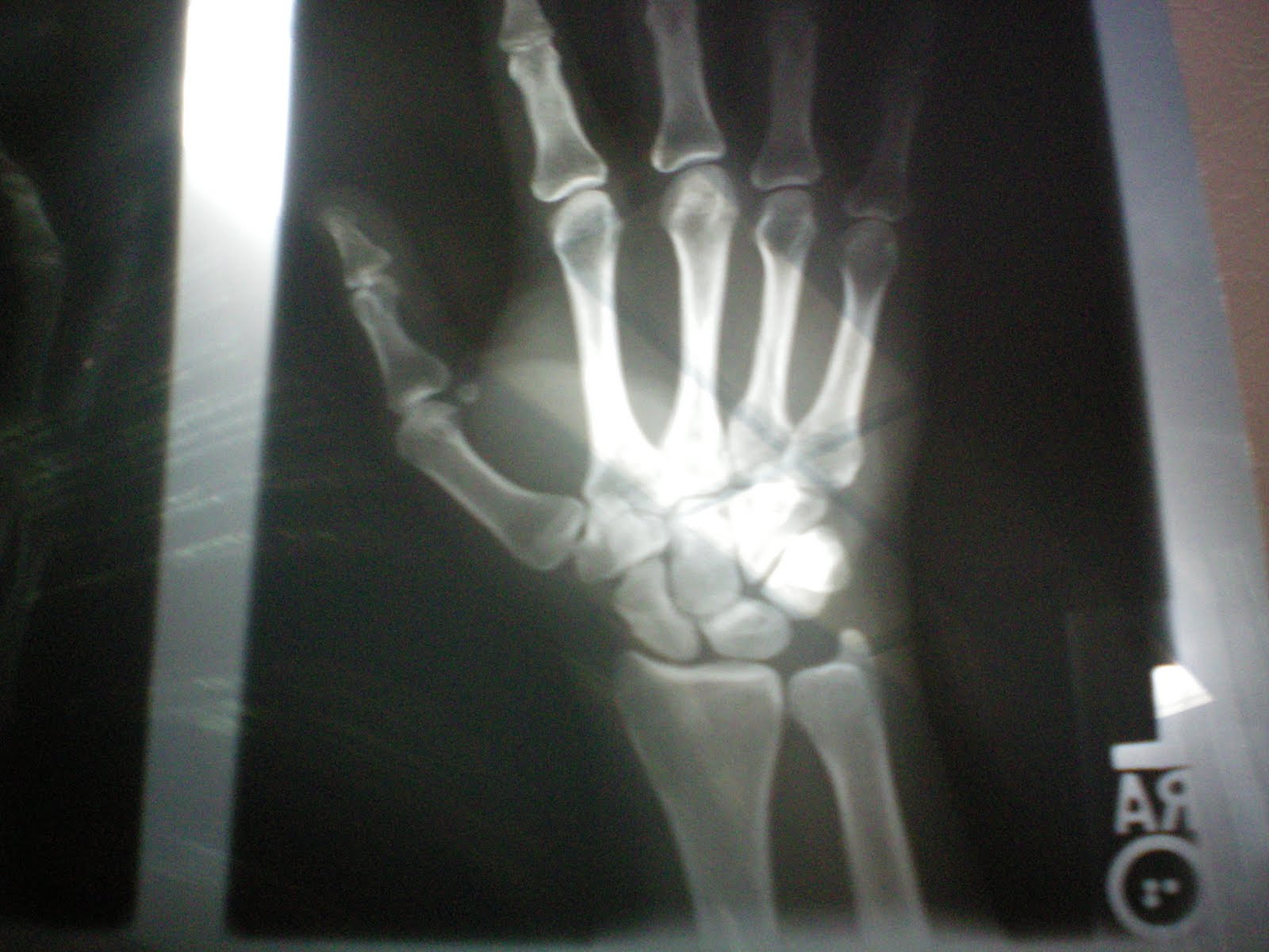 X Ray Pictures Of Broken Bones - 1600x1200 - jpeg X Ray Pictures Of Broken Bones