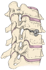 Healthbase - Interfusion Spine Surgery