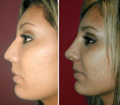 Rhinoplasty Pictures