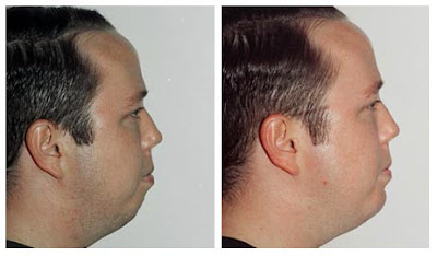 Chin Augmentation Before And After