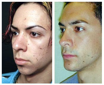 Chin Implants