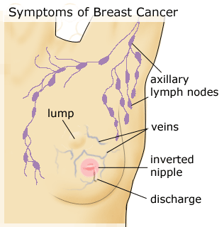 Early Signs Of Breast Cancer