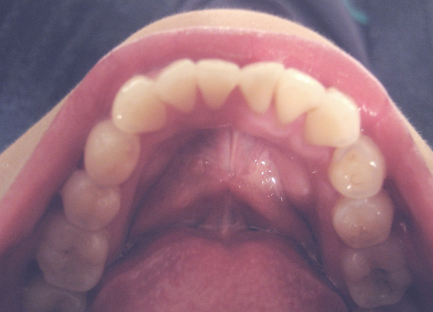 sloth sid invisalign ice braces age trays lin aka l22 diary clear experience