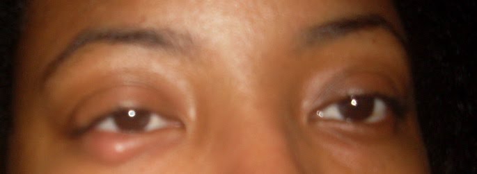 inflamed eyelash follicle